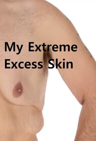 My Extreme Excess Skin